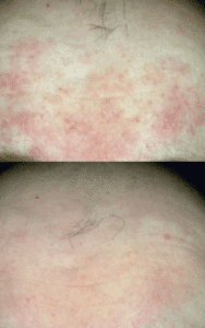 resultaat behandeling rosacea resultaat behandeling rosacea malden