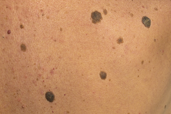 Skin Abnormalities