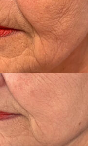 huidverjonging voor en na