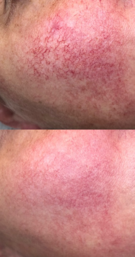 lichtlaser-2-263×500