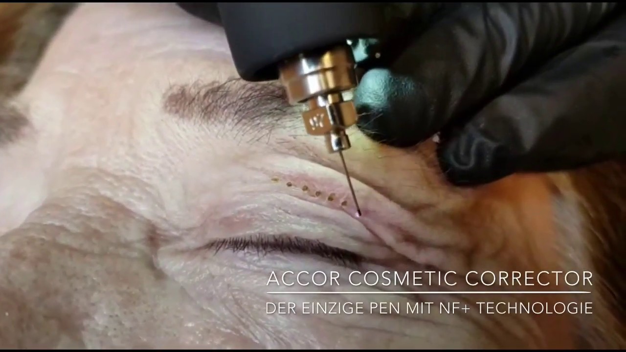 Plasma lift oogleden