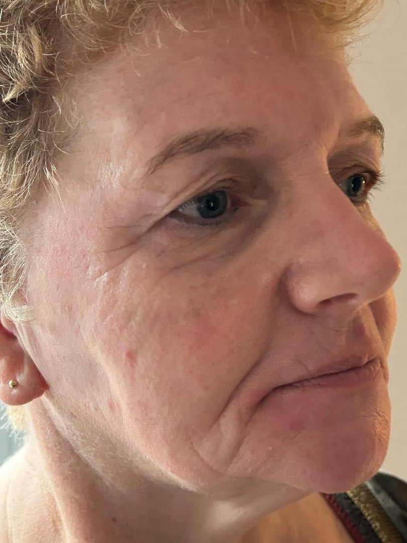 Herstel Cosmo Peel Forte Malden