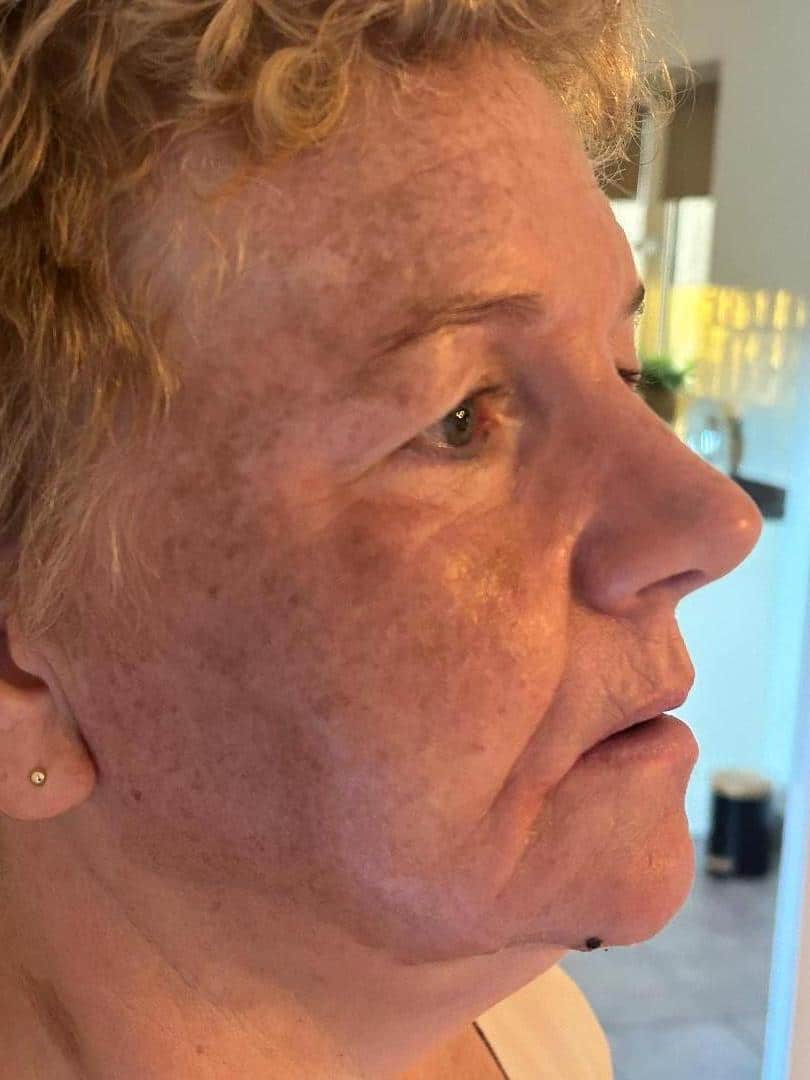 Herstel Cosmo Peel Forte Malden