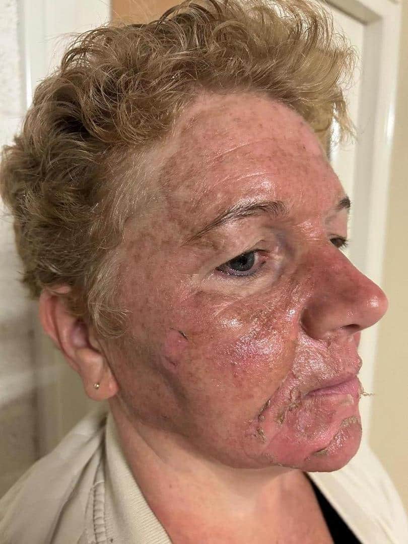 Herstel Cosmo Peel Forte Malden