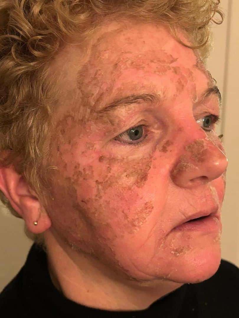 Herstel Cosmo Peel Forte Malden