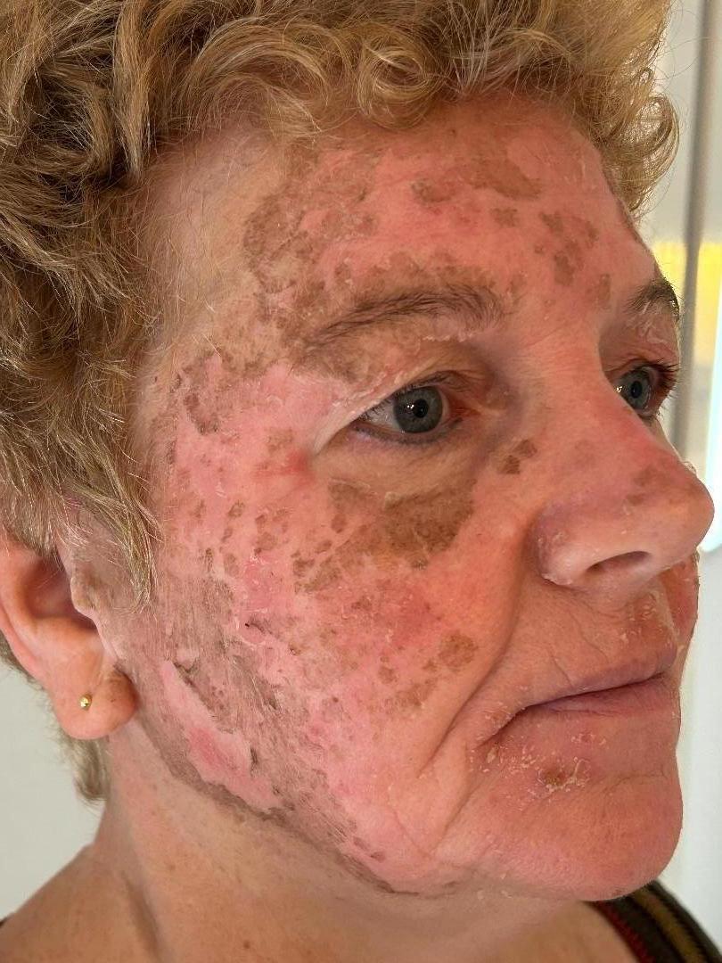 Herstel Cosmo Peel Forte Malden