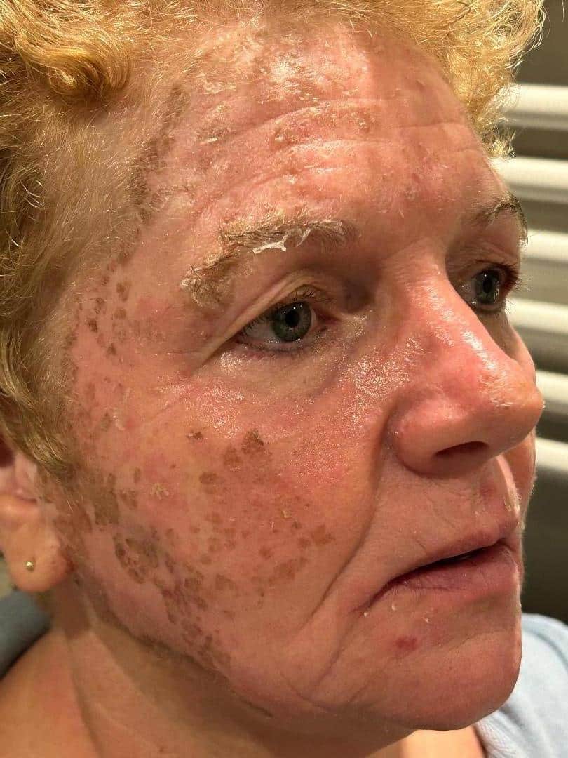 Herstel Cosmo Peel Forte Malden