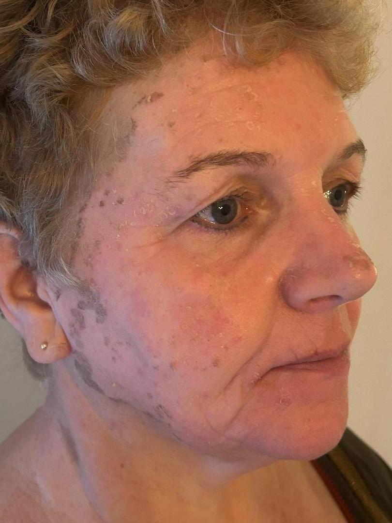 Herstel Cosmo Peel Forte Malden