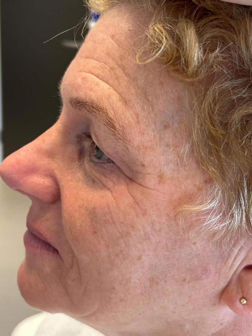 Cosmo Peel Forte resultaat behandeling Malden