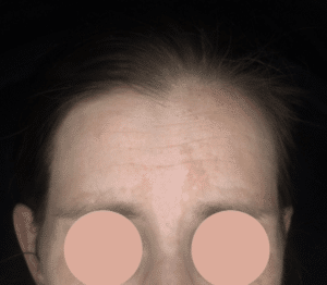 behandeling melasma malden