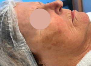 pigment behandeling voor