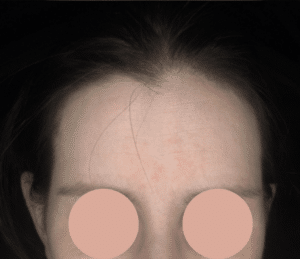 resultaat behandeling melasma malden