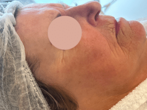 resultaat pigment behandeling