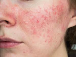rosacea wangen rosacea behandelen malden